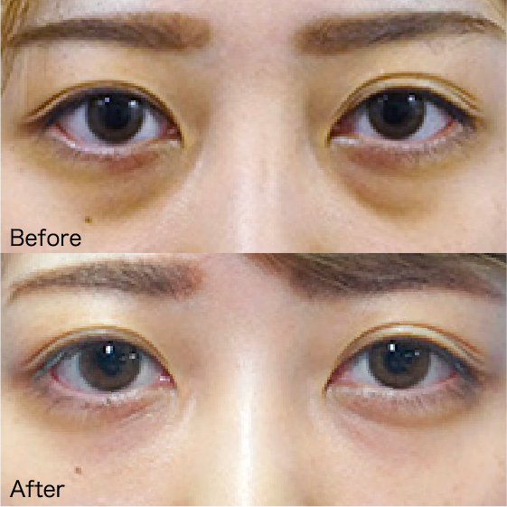 Under-Eye Bag Removal Before & After