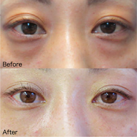 Under-Eye Bag Removal Before & After
