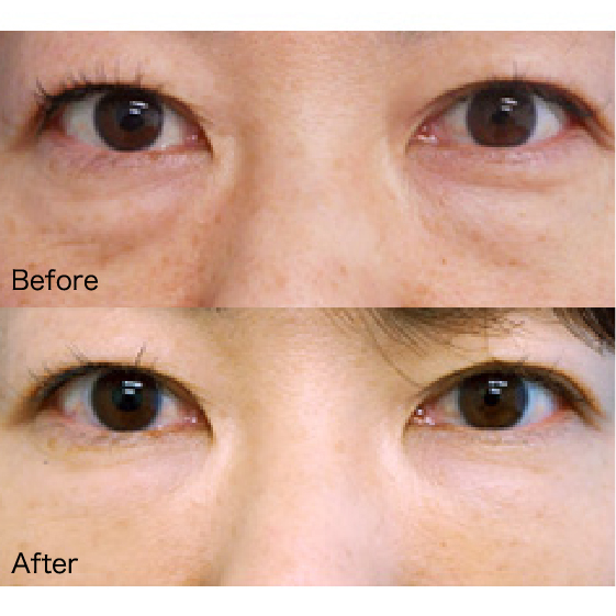 Under-Eye Bag Removal Before & After