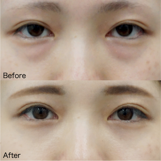 Under-Eye Bag Removal Before & After