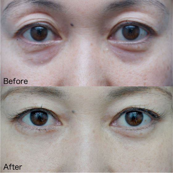 Under-Eye Bag Removal Before & After