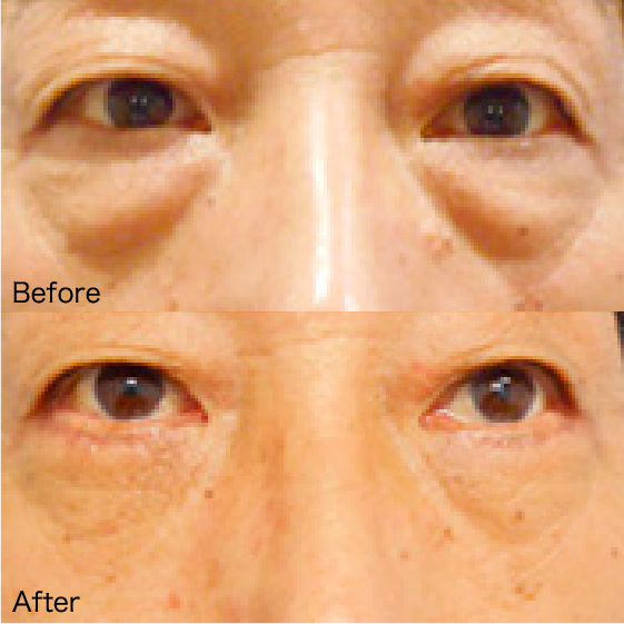 Under-Eye Bag Removal Before & After