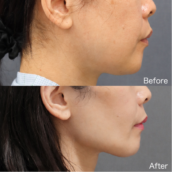 Thread Lift Before & After