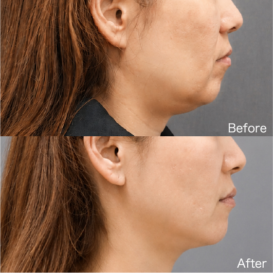 Thread Lift Before & After