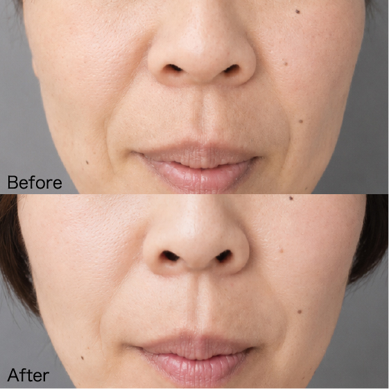 Lasolabial folds Before & After