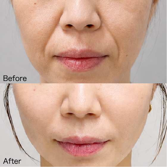 Lasolabial folds Before & After