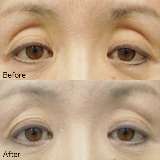 Hollows above the eyes Before & After