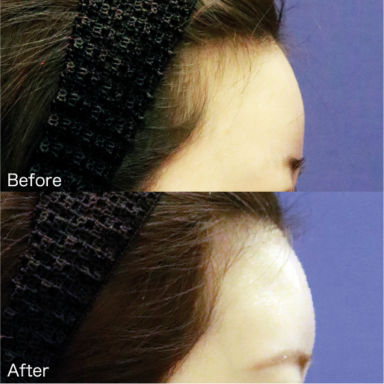 Hollows above the eyes Before & After