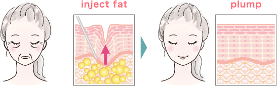 inject fat, plump