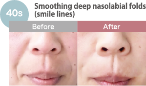 Smoothing deep nasolabial folds (smile lines)