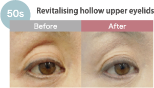 Revitalising hollow upper eyelids