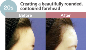 Creating a beautifully rounded, contoured forehead