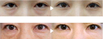 Under-Eye case photo