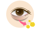 Under-Eye Bag Removal
