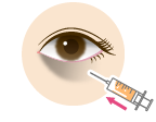 Under-Eye Bag Removal