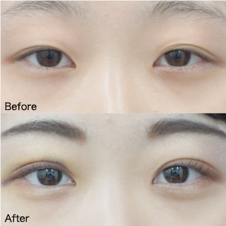Double Eyelid Surgery Before & After
