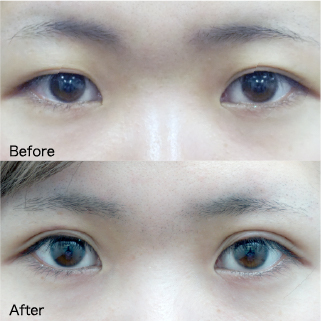 Double Eyelid Surgery Before & After