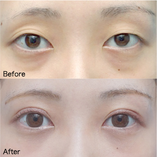 Double Eyelid Surgery Before & After