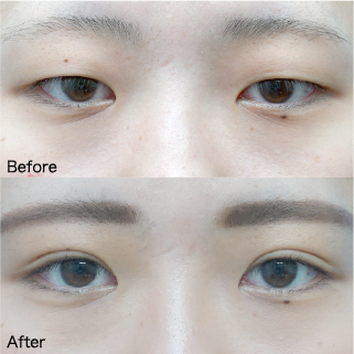 Double Eyelid Surgery Before & After