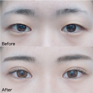 Double Eyelid Surgery Before & After