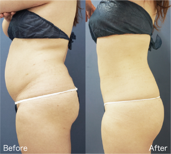 Liposuction Before & After