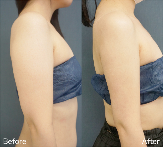 Liposuction Before & After