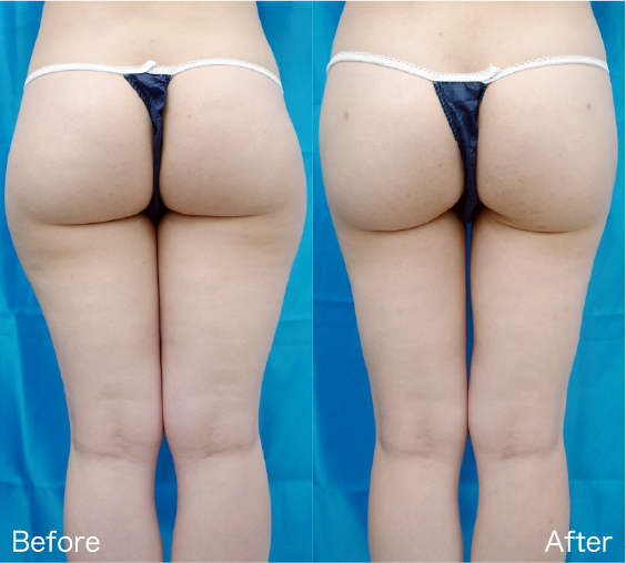 Liposuction Before & After