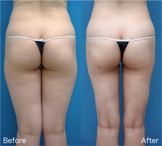 Liposuction Before & After