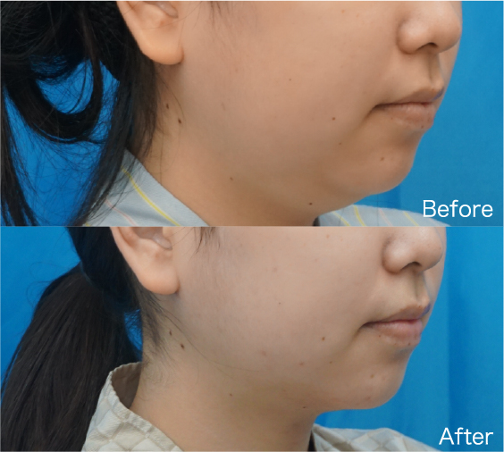 Liposuction Before & After