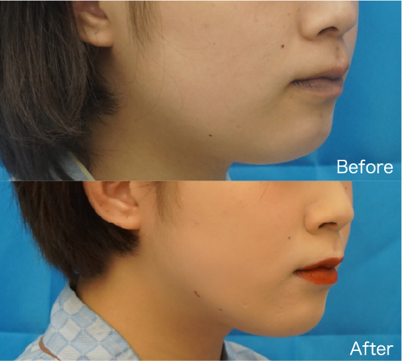 Liposuction Before & After