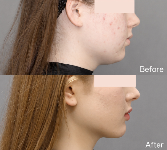 Liposuction Before & After