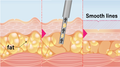 High-Precision Syringe Method:The Handcrafted Touch